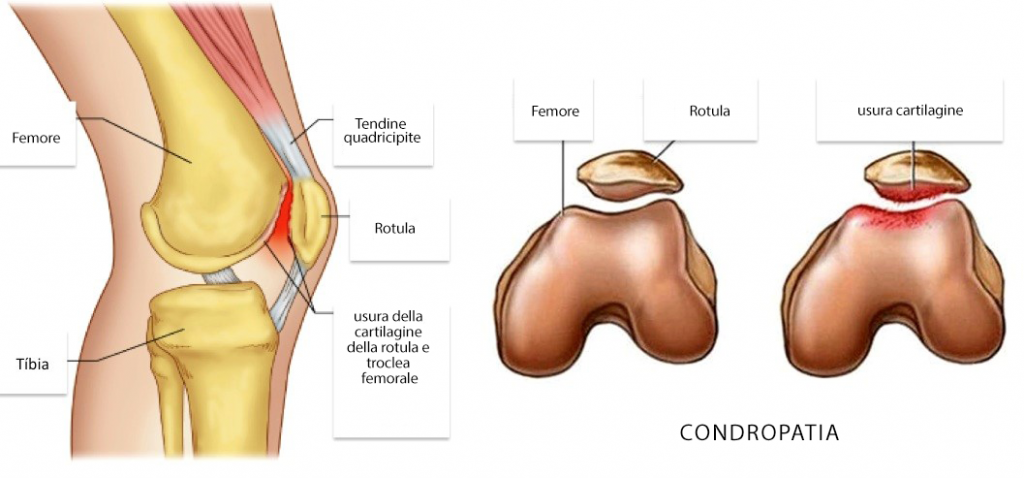 Condropatia 