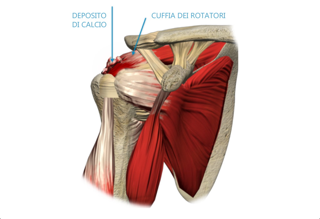 Tendinopatia Calcifica